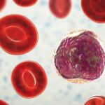 Myelodysplastic syndrome
