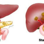 Pancreatic cancer
