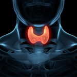 Thyroid cancer