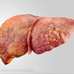 fatty liver disease