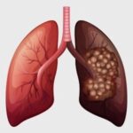 lung cancer