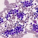 Chronic myeloid leukaemia