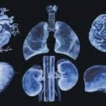 Prevention of organ rejection in transplant patients