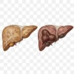Non-Alcoholic Fatty Liver Disease