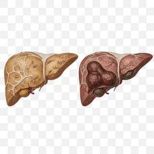 Non-Alcoholic Fatty Liver Disease