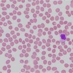 thrombocytopenia