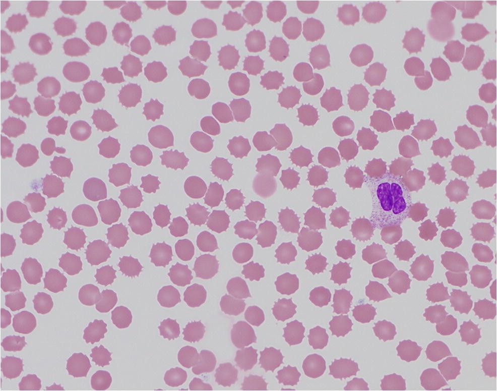 thrombocytopenia